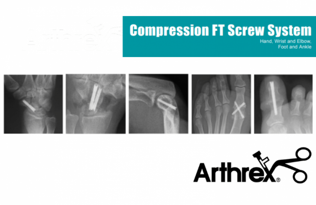 New In The Treatment Of Hand And Foot Bones Arthrex Compression Ft