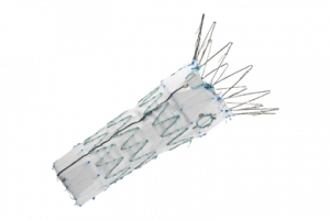 Abdominal aortic stent grafts